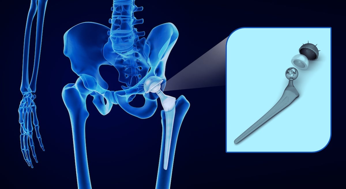 6-signs-that-it-might-be-time-for-a-hip-replacement-intellijoint-surgical