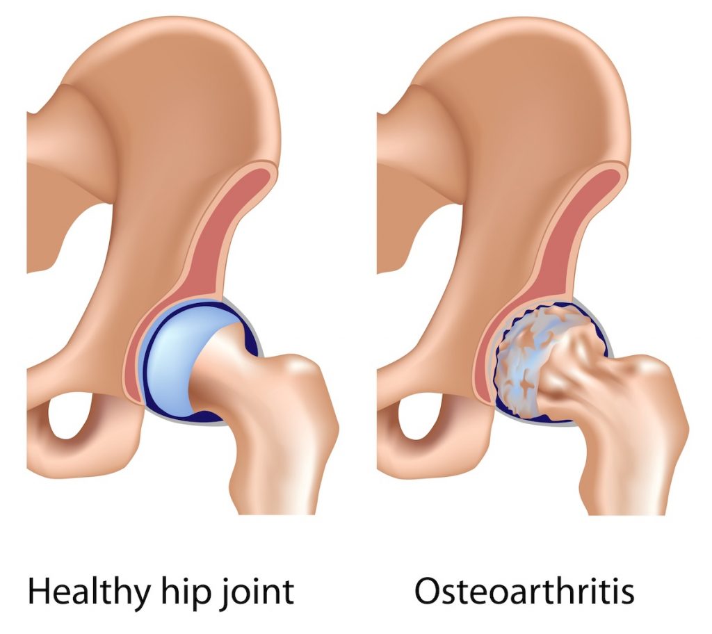 6 Signs That it Might be Time for a Hip Replacement